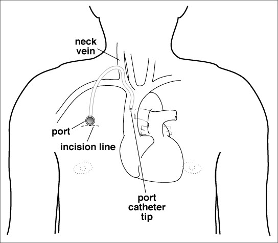 SIR RFS on X: IR Procedure Starter Kit Subcutaneous port placement (eg:  port-a-cath) is a procedure that involves the placement of an implanted  device with the tip positioned at the cavoatrial junction