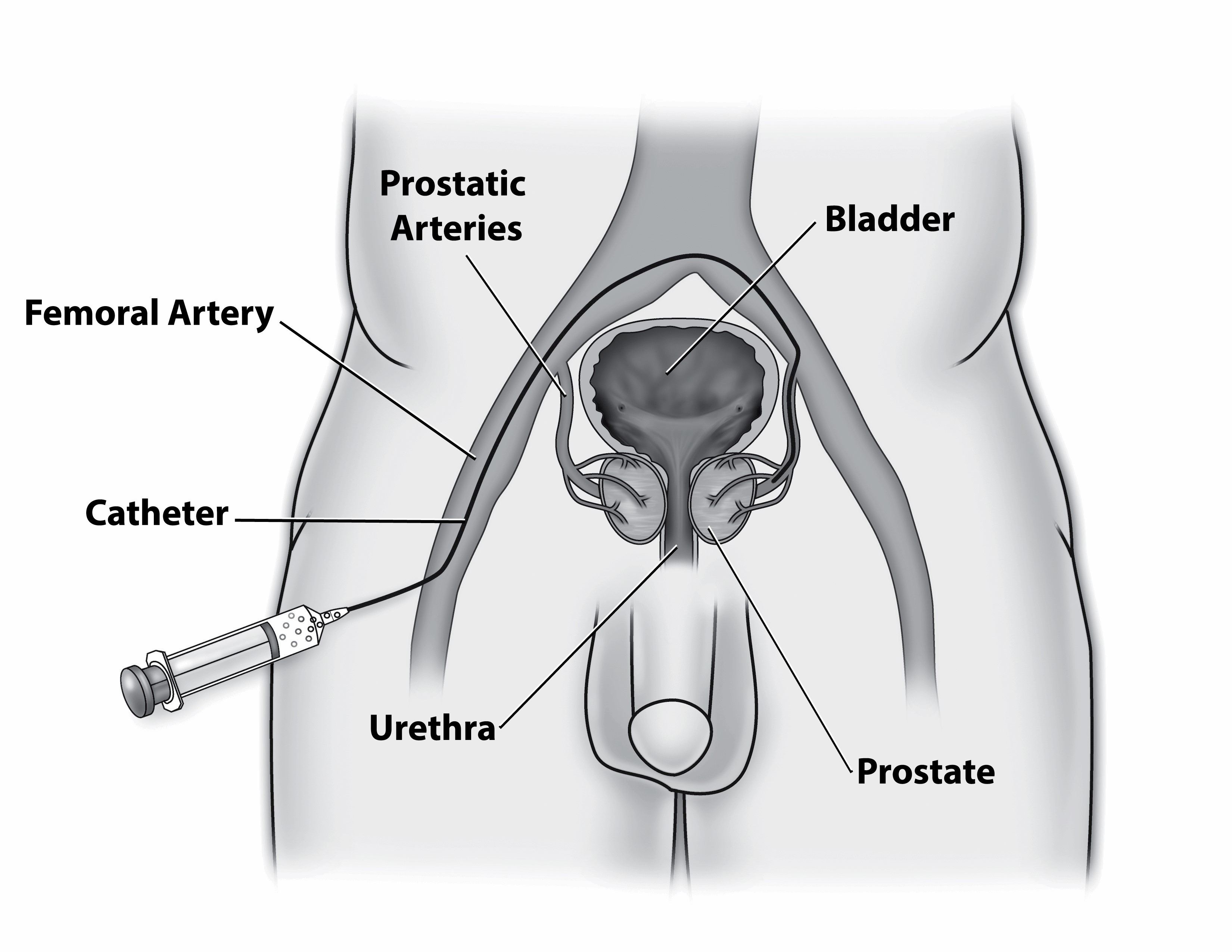 8058 Prostate Artery Embolization