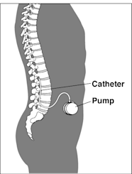 Intrathecal Baclofen Pump For Severe Spasticity And Dystonia 