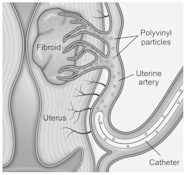 Uterine Artery Embolization UAE To Treat Fibroids Treatments Uterine Artery Embolization UAE To Treat Fibroids Treatments