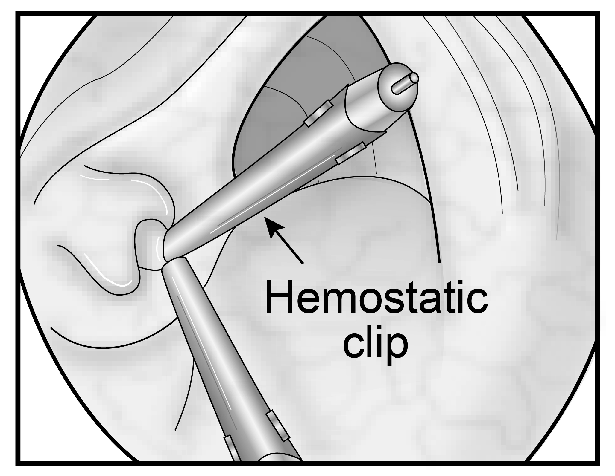 7708 Hemostclip