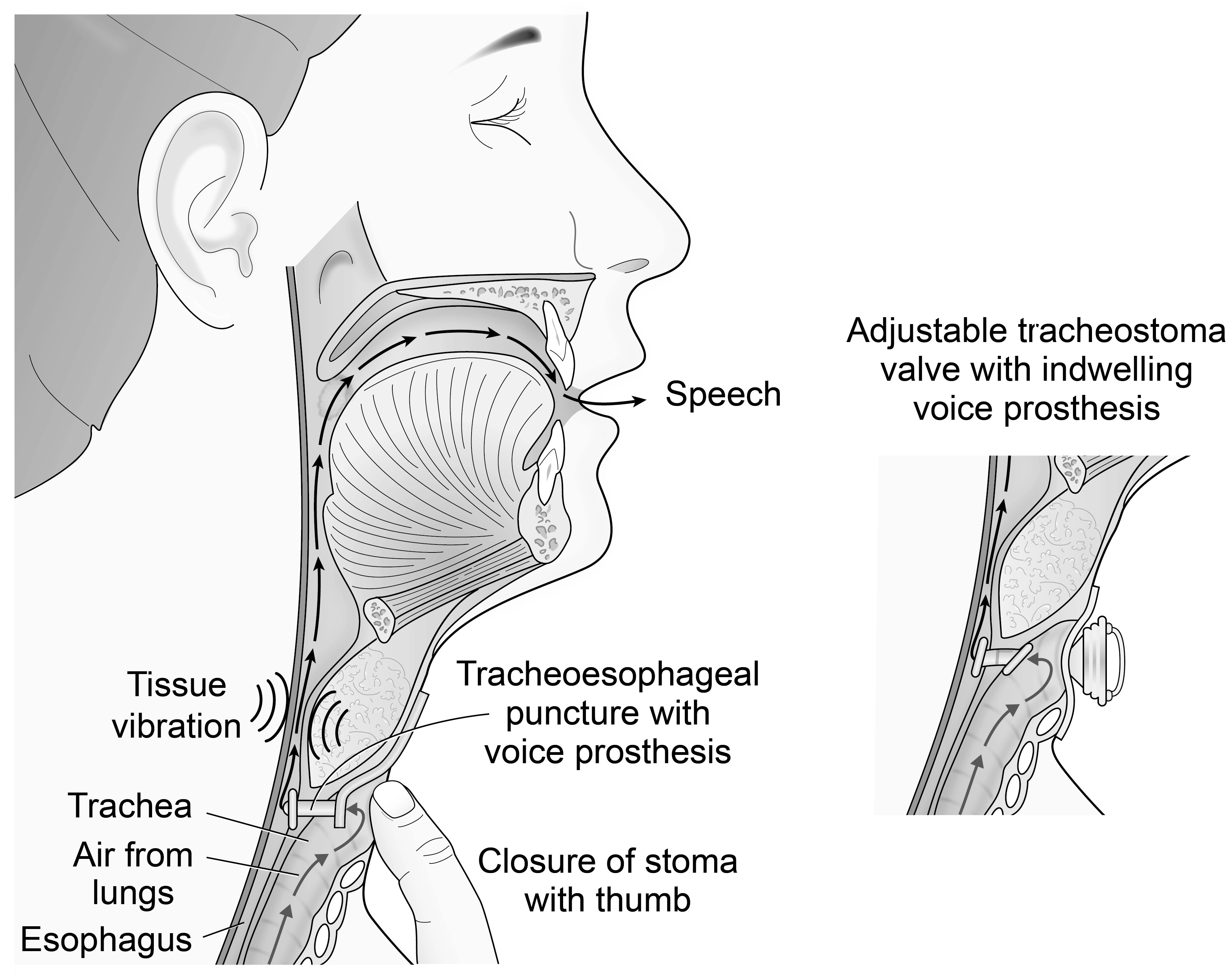 laryngectomy anatomy