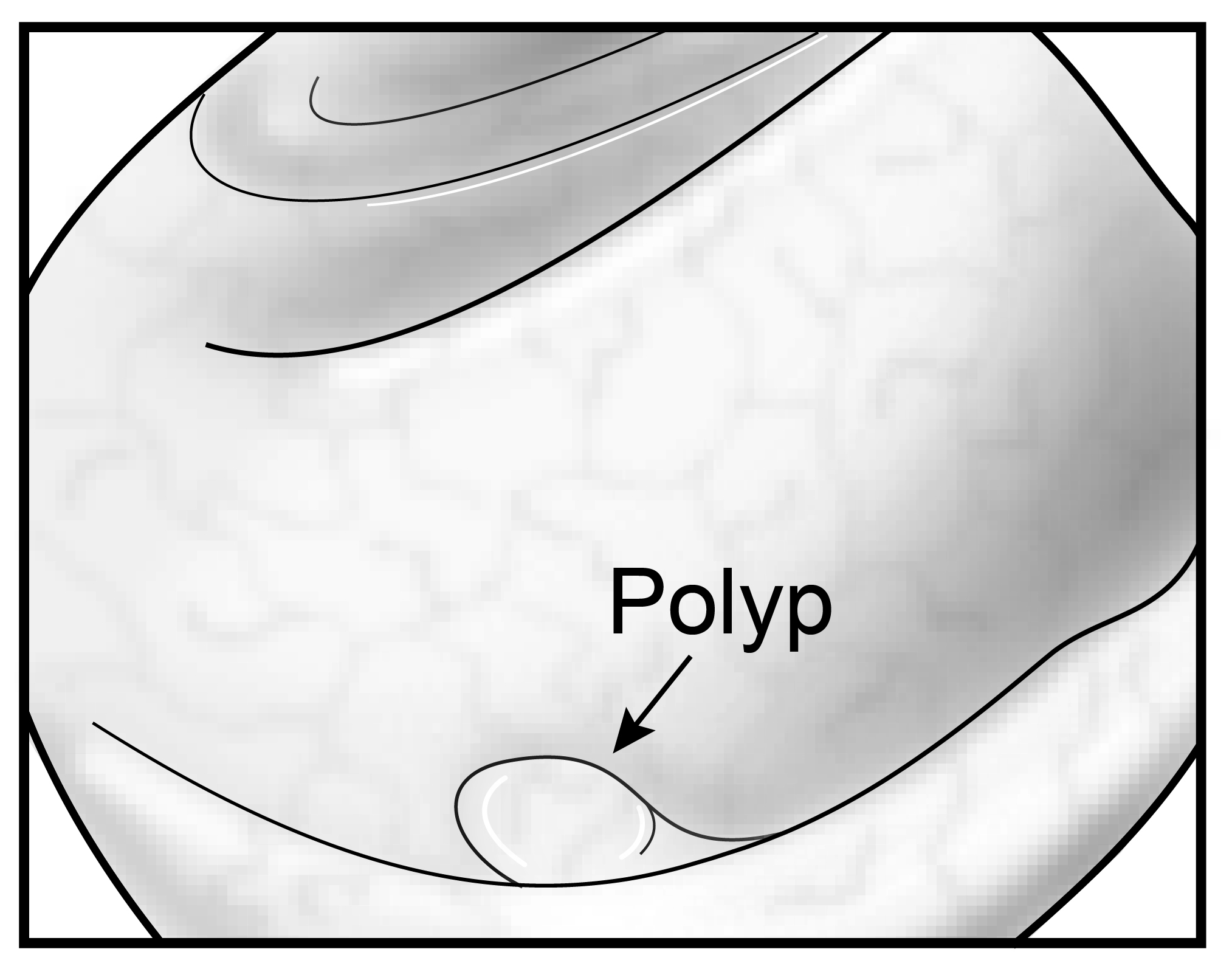 7708 Polyp