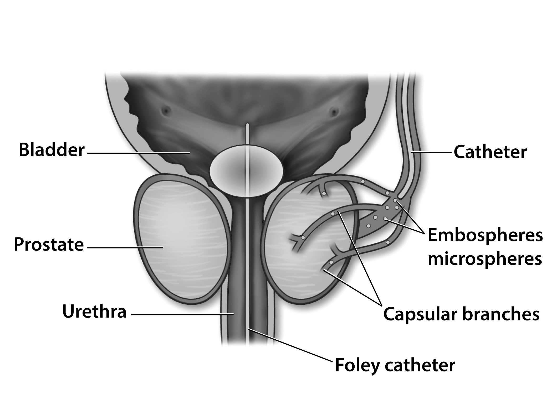 Preparing For Your Prostate Artery Embolization Pae Treatments Patients And Families Uw Health 6029