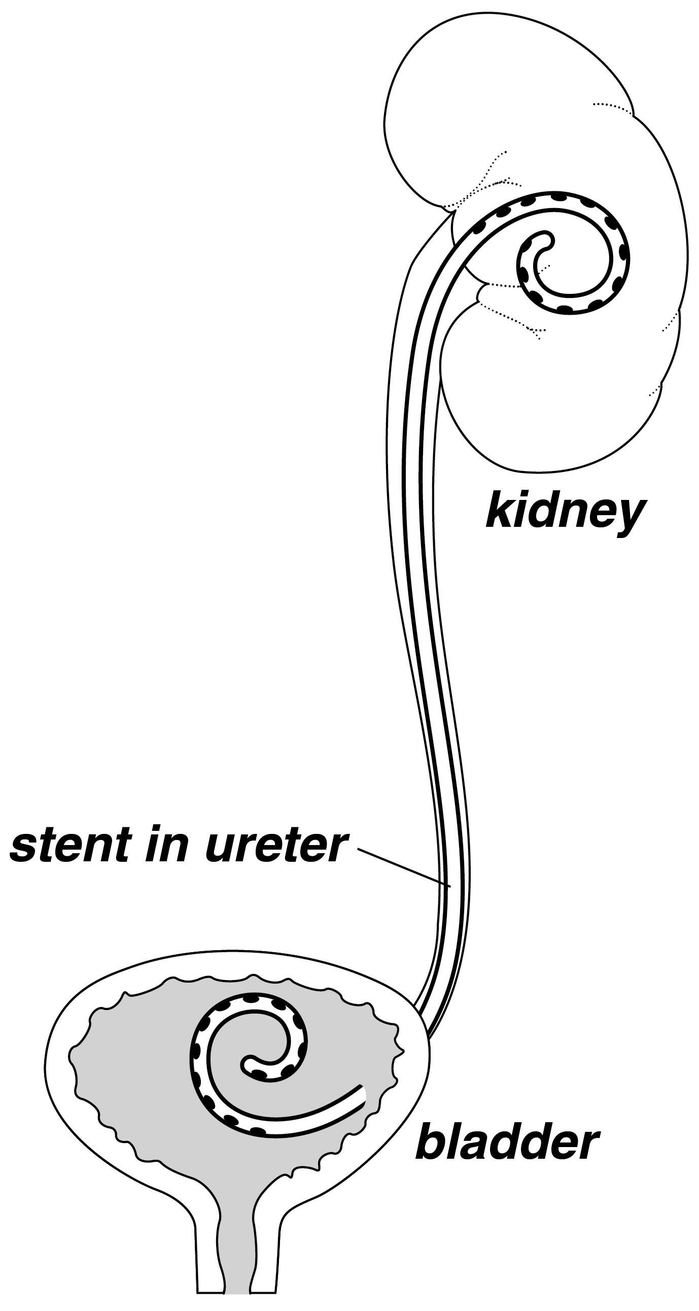 Can You Drink Alcohol With a Kidney Stent?