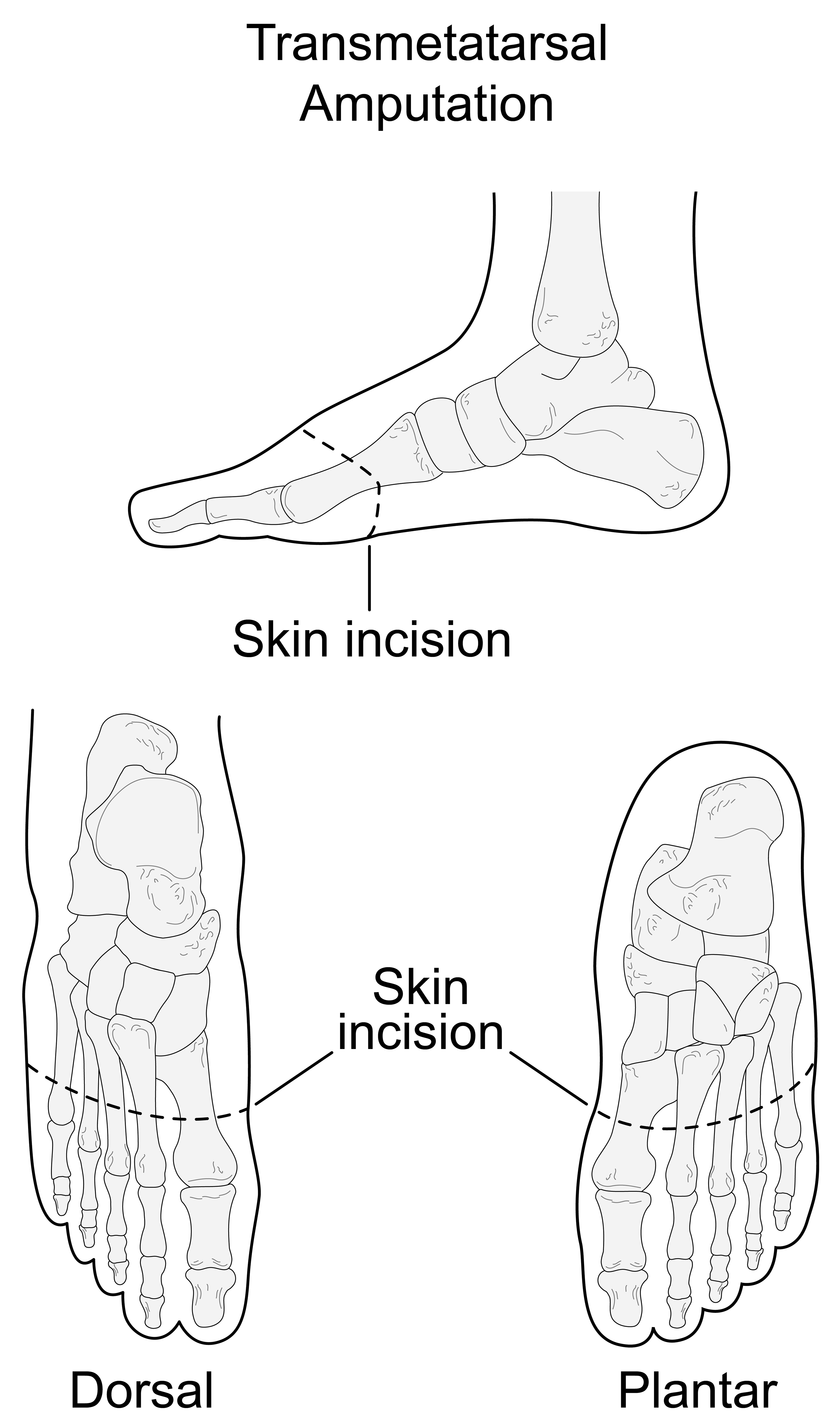 Toe amputation cpt