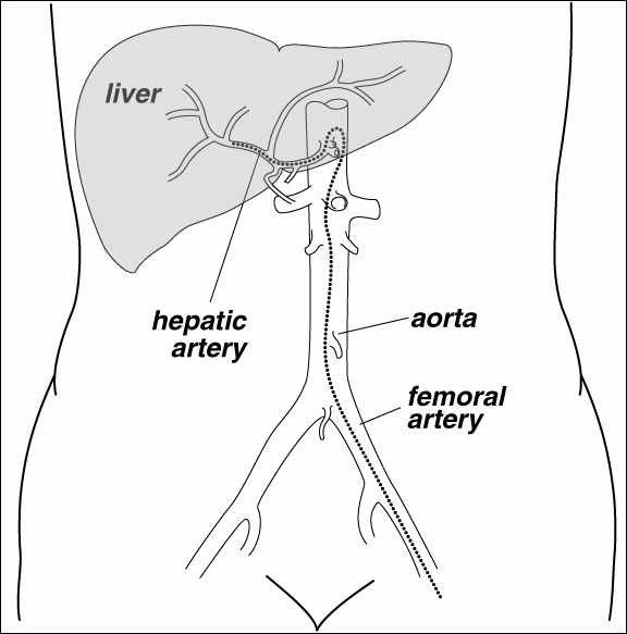 Hepatic Artery