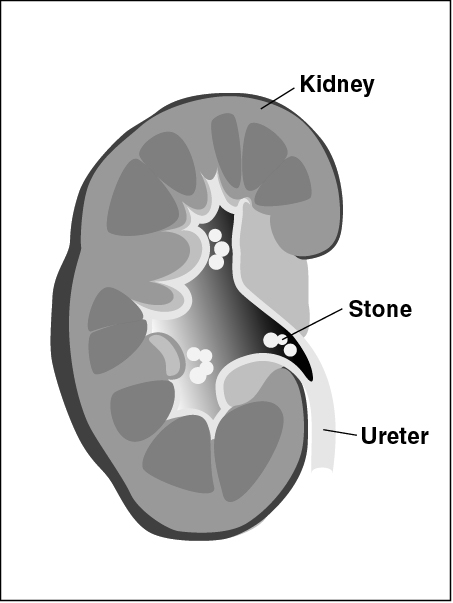 percutaneous lithotripsy