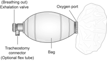 INDIA INVENTS Ambu bag Ventilator gets new life with COVID 19