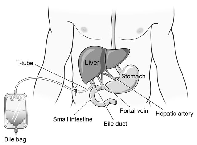 Percutaneous Cholecystostomy