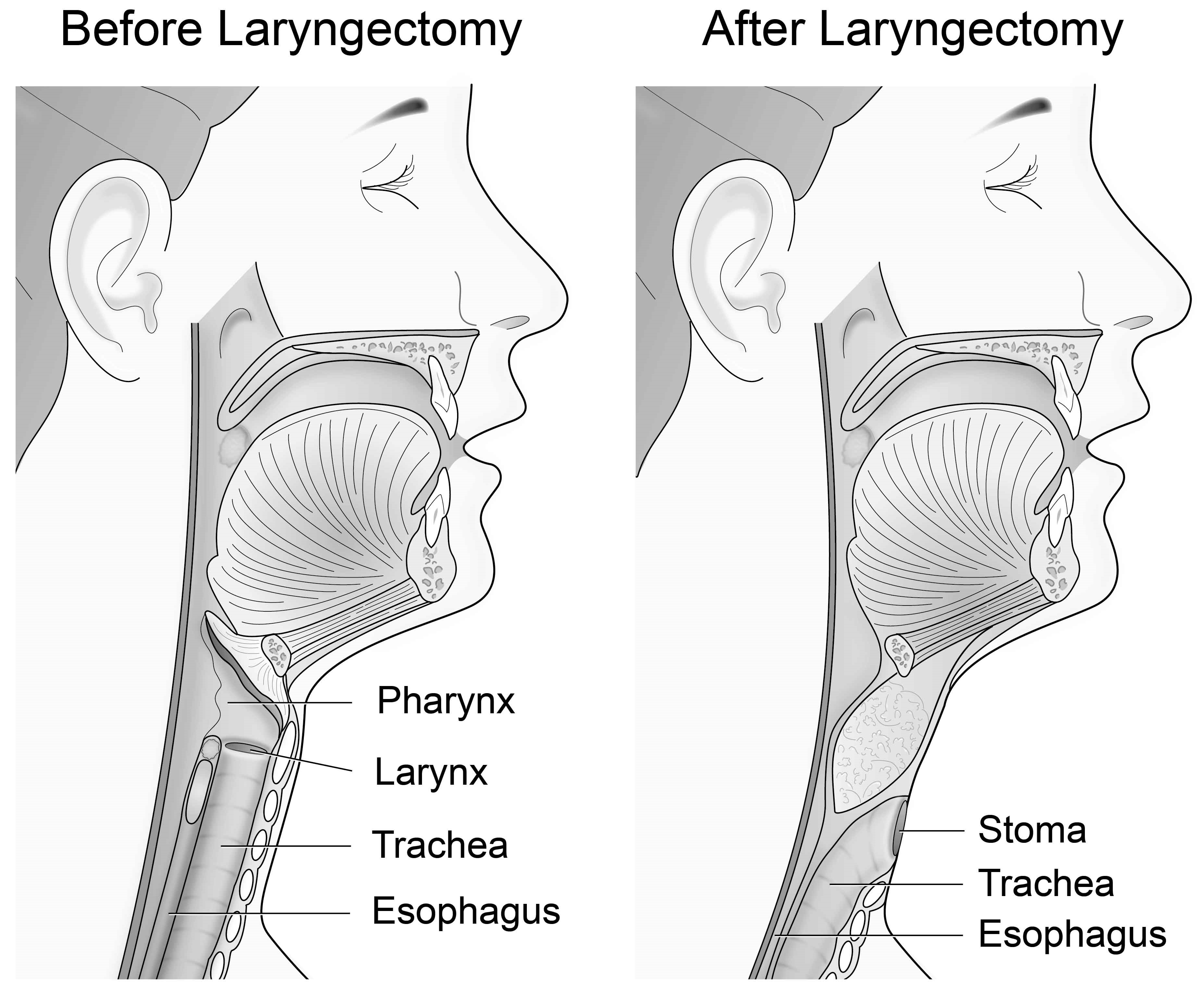 Total Laryngectomy 1