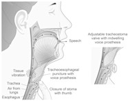 Laryngectomy Care Of Stoma Care Of Laryngectomy Stomas In General 
