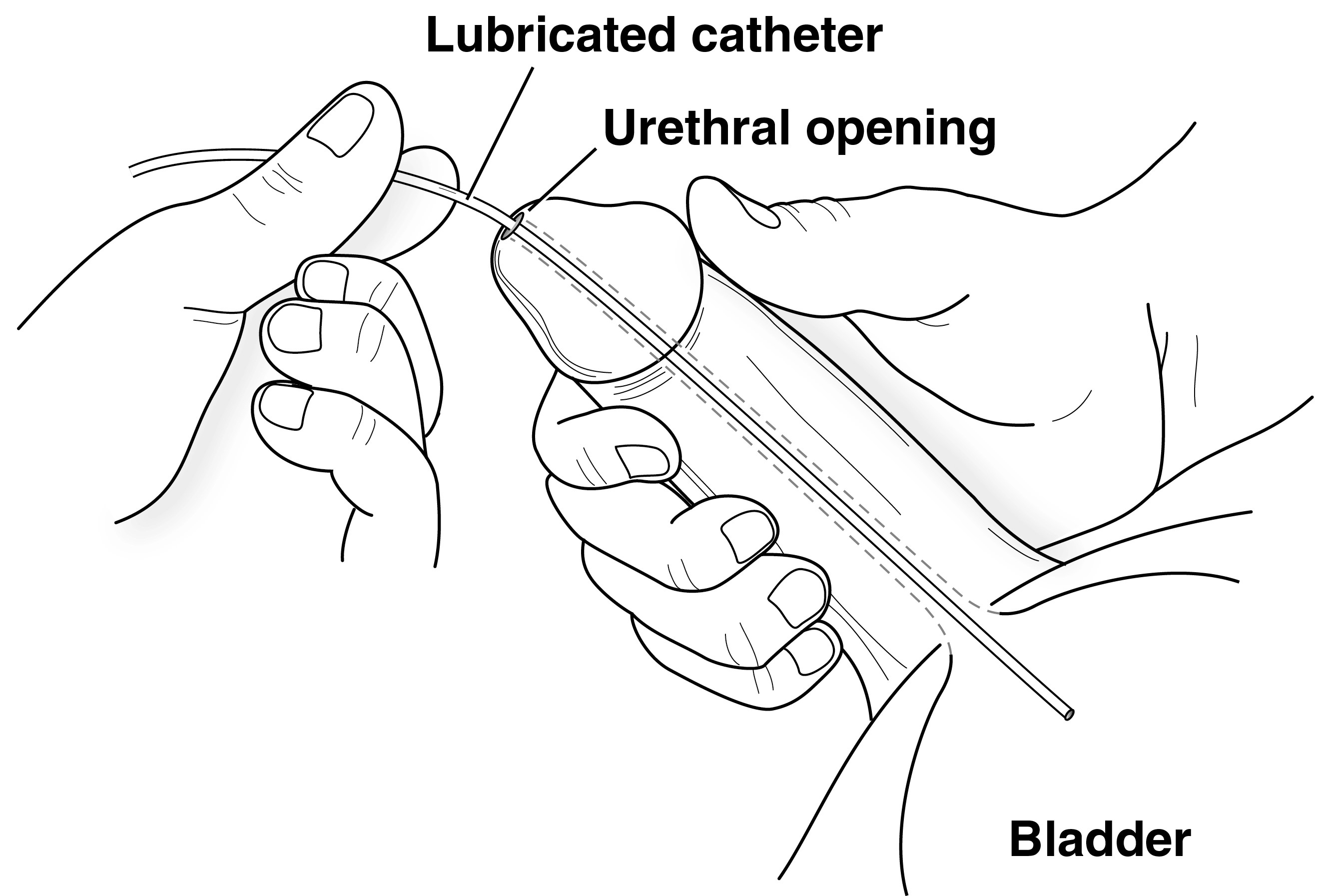 Male Catheterization