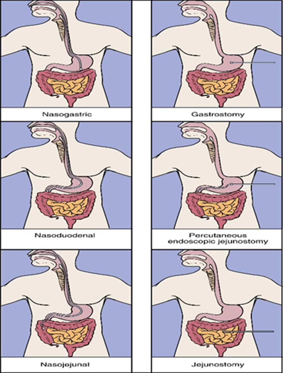 Understanding Your Nasal Feeding Tube | Patients & Families | UW Health
