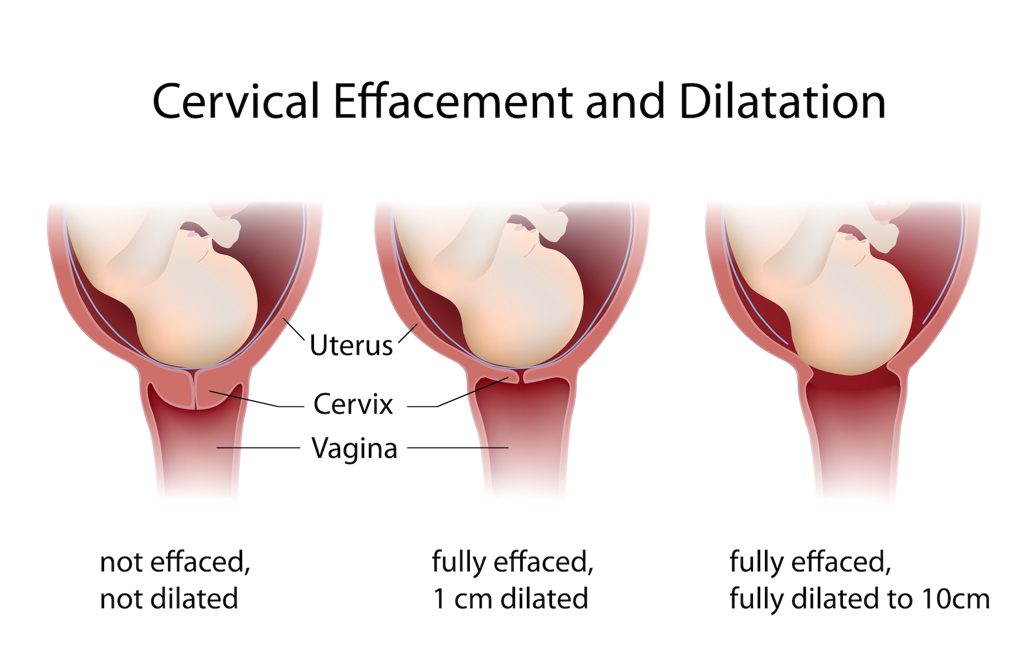 Pregnancy Effacement Chart