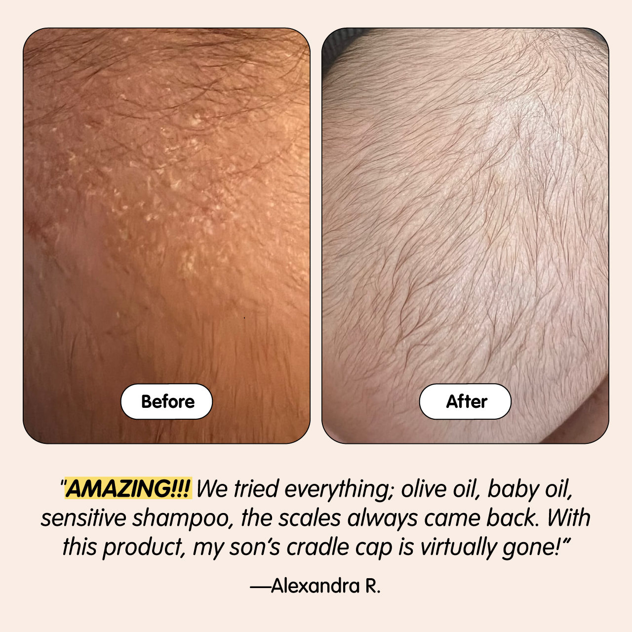 Tubby Todd Bye-Bye Cradle Cap Bundle.