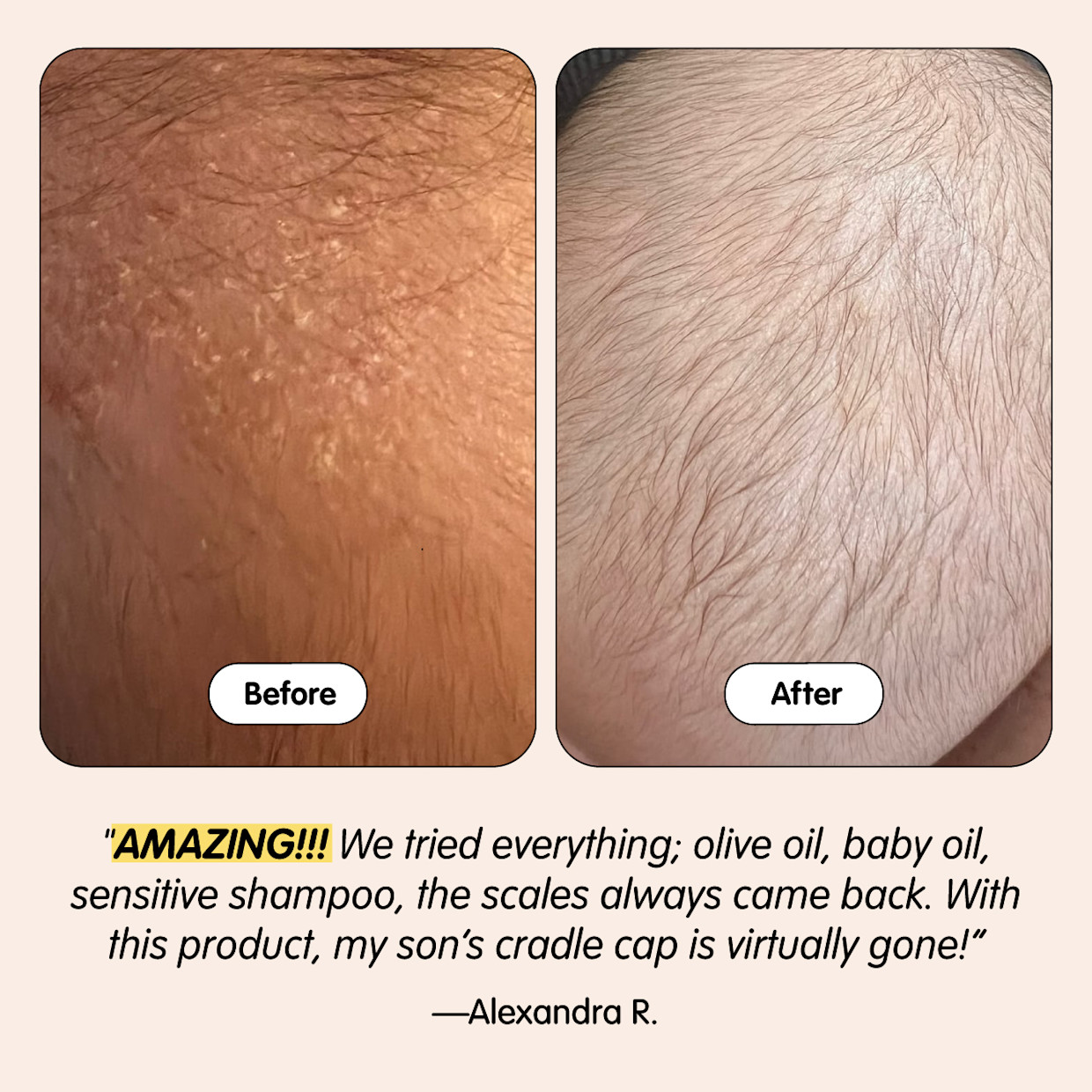 Tubby Todd Bye-Bye Cradle Cap Bundle.