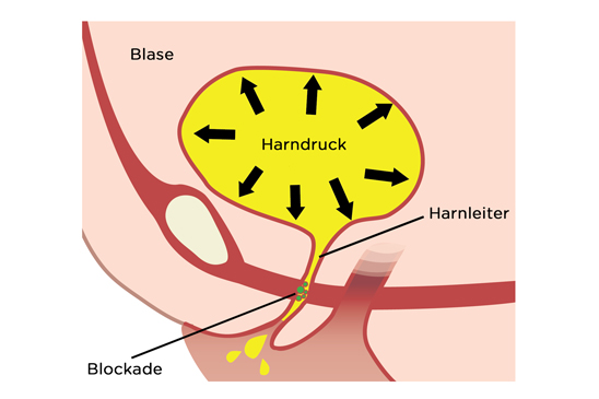 Verstärkter Druck In der Blase. Überlaufinkontinenz gehört zu den Inkontinenz arten