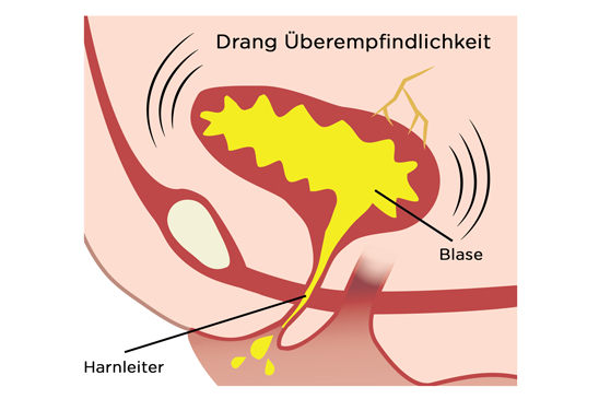 Verstärkter Druck In der Blase. Dranginkontinenz