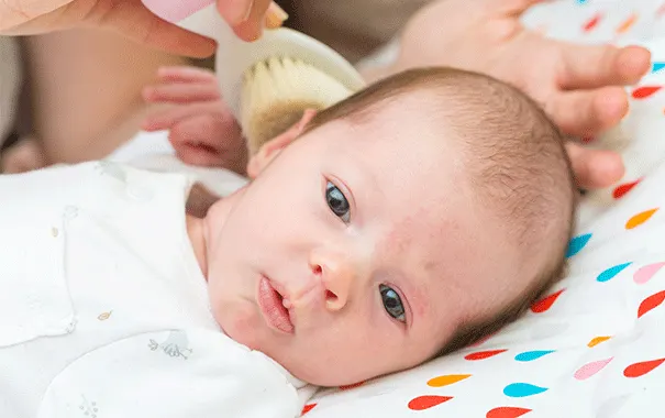Comment soigner les croûtes de lait de mon bébé de trois mois ? 