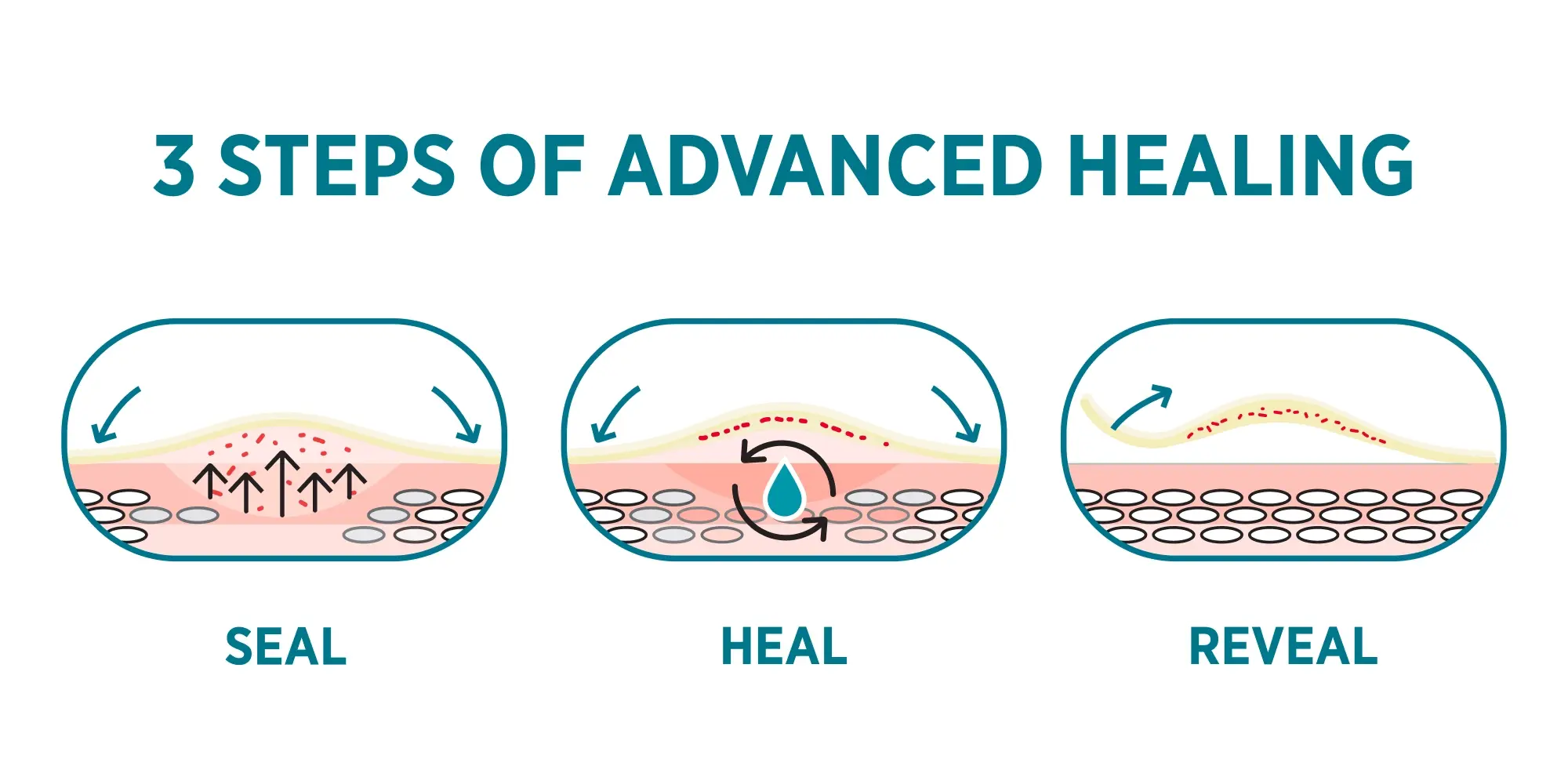 Hydrocolloid technology - how it helps skin heal better, 3 Steps of advanced healing