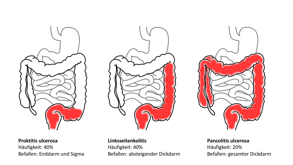 Pancolitis ulcerosa dieta