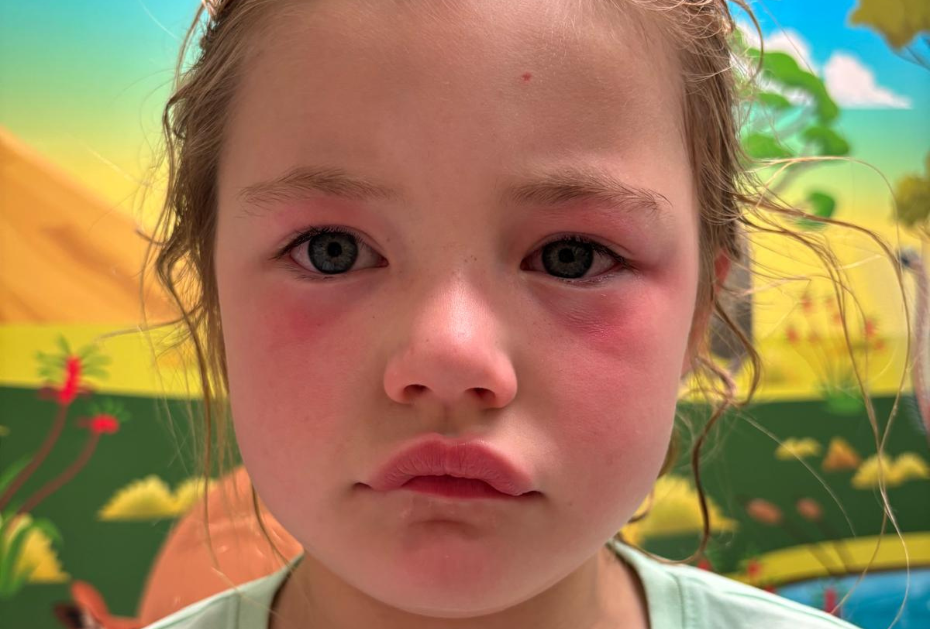 Luca second pic with eye burns