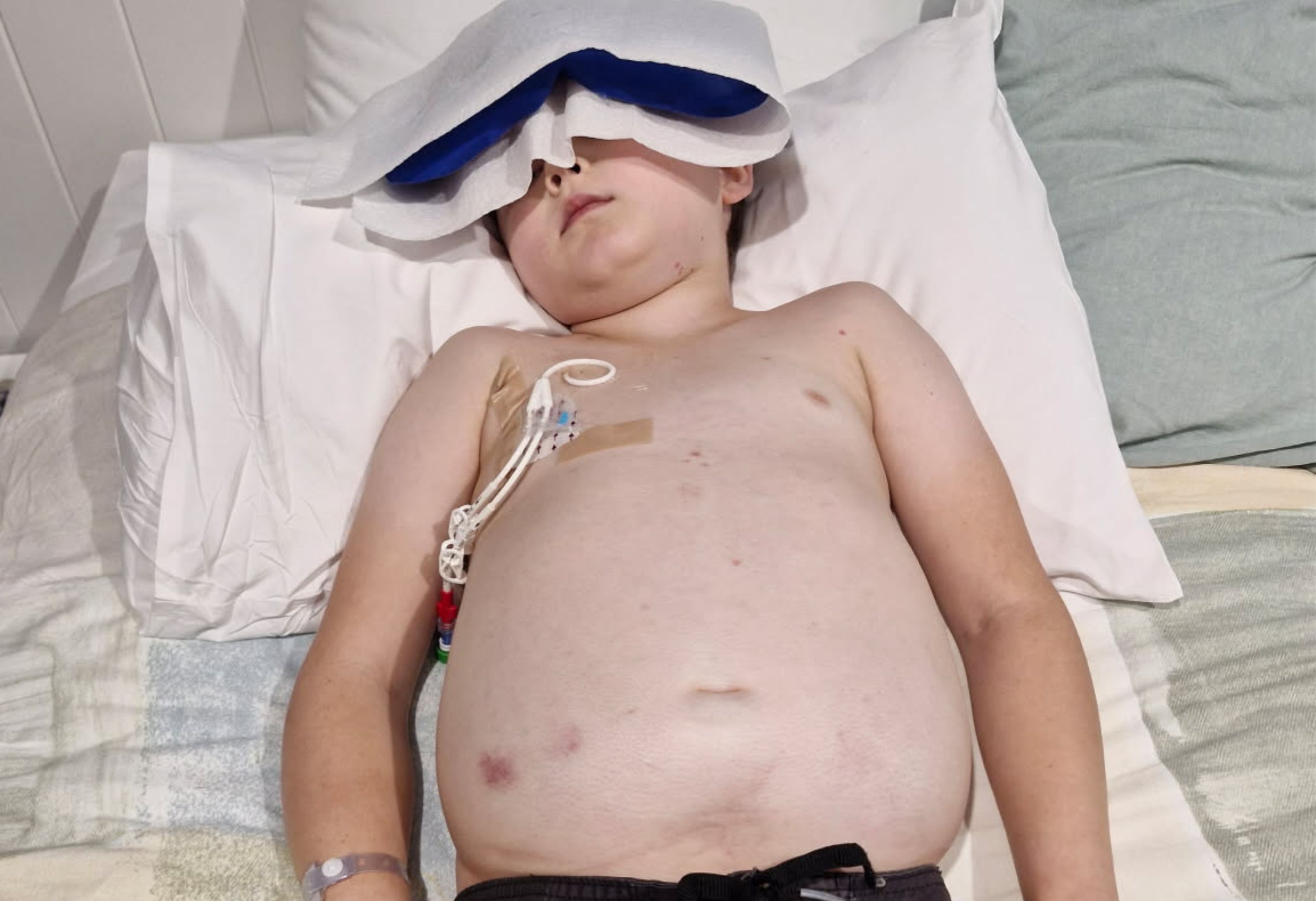 Desmon swelling