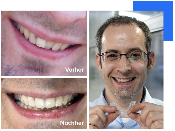Schiefe Zähne: Vorher & Nachher – DrSmile Zahnschiene