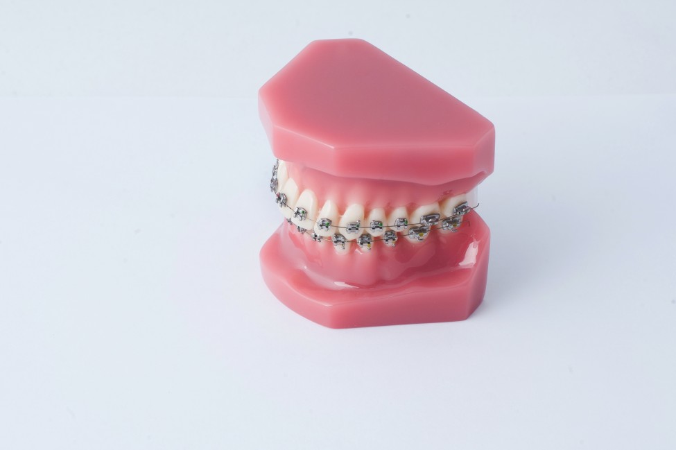 Aparatos dentales: tipos y precios [2022]