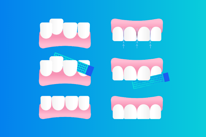 Ilustración del antes y después de un stripping dental