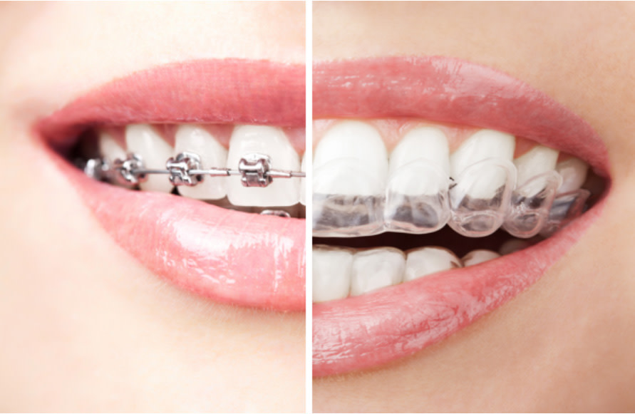 Brackets vs Aligner