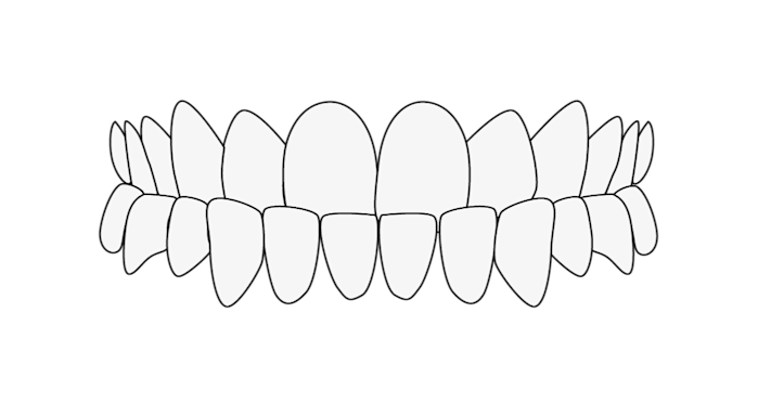 Malocclusione 3 classe underbite