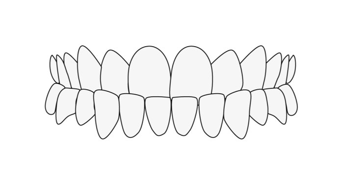 Underbite dentaire