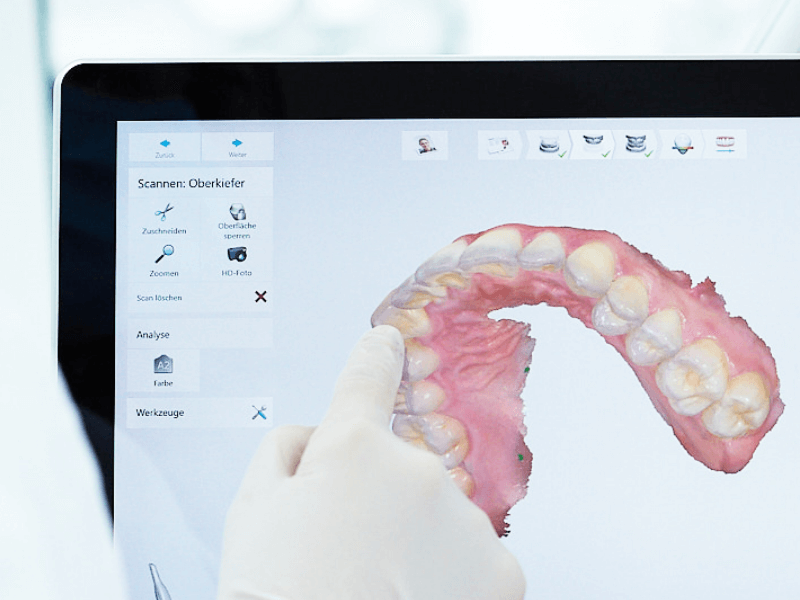 Empreinte dentaire numérique grâce au scan 3D DR SMILE