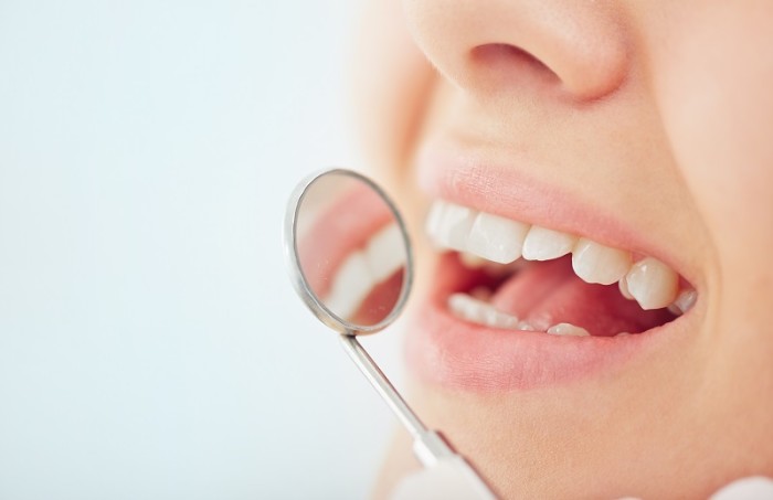Gerade Zähne mit einer Zahnschiene
