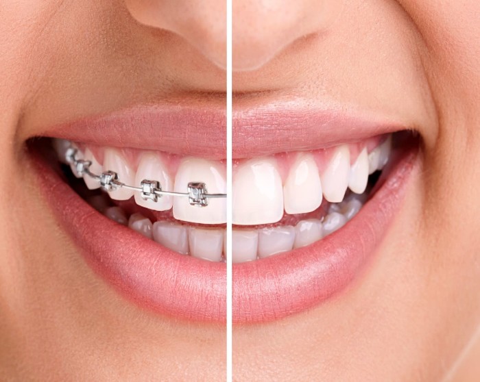 Zahnschiene oder Zahnspange? Vergleich gesplittetes Bild