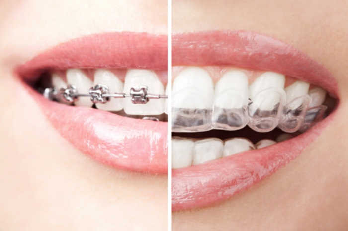Tandskena eller tandställning?