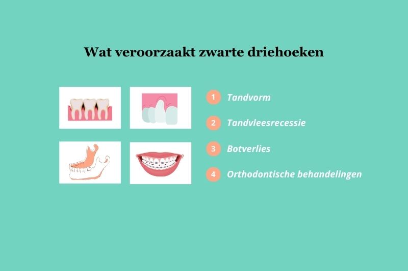 de oorzaken van zwarte driehoeken bij tanden