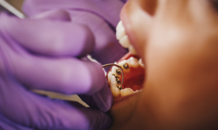 Mujer con brackets linguales