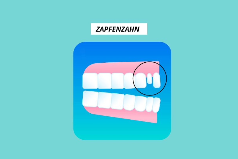 Grafik eines Zapfenzahns
