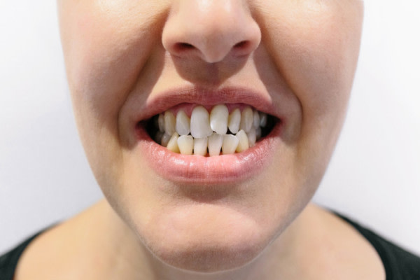 Mund einer Frau mit Zahnanhaftung