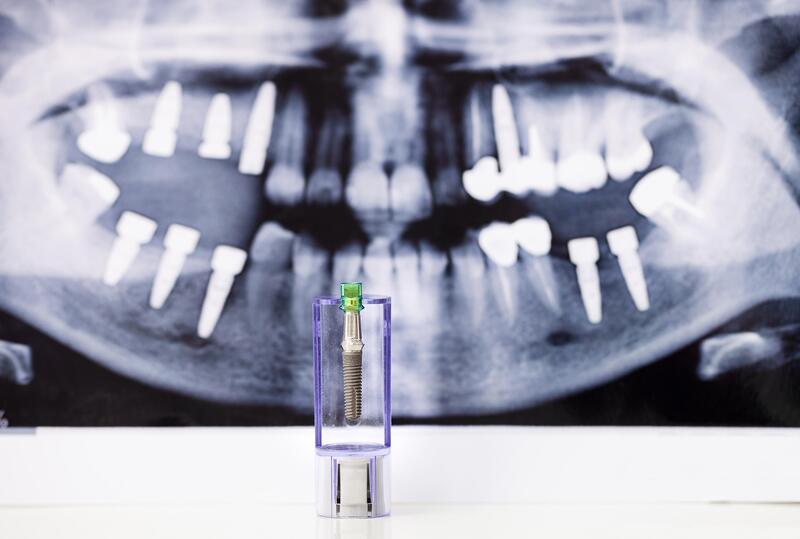 Scan d'une mâchoire avec implants dentaires et vis