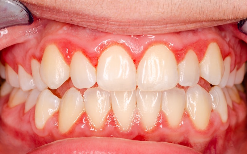 Encias con periodontitis