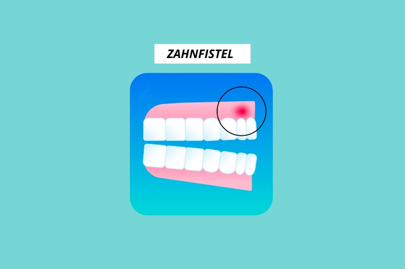Was ist eine Zahnfistel?