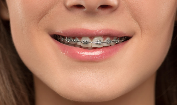 Mujer con brackets metálicos