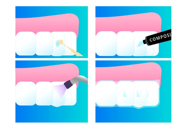 Illustrazione procedura applicazione attacchi ortodontici