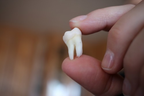 Zęby mądrości: objawy, ból i usuwanie
