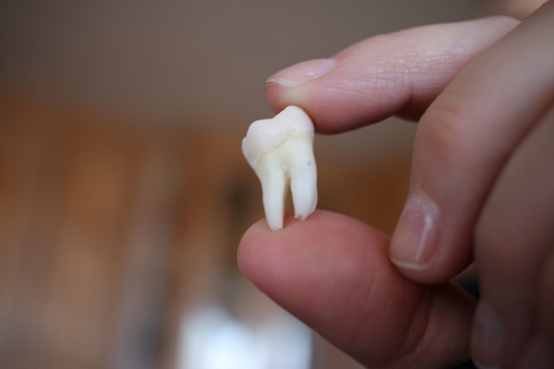 Gezogener Weisheitszahn Wisdom teeth