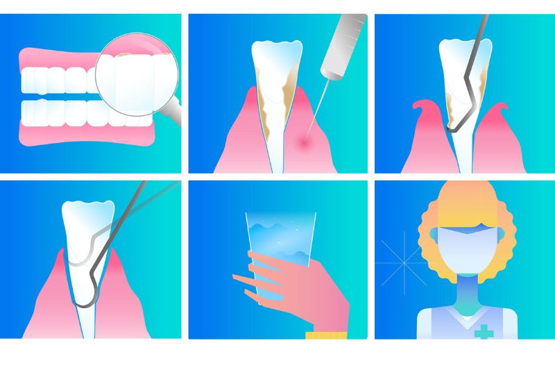 Paso a paso cómo se hace un curetaje dental